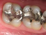 Chất hàn amalgam nha khoa