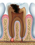 Phân loại bệnh lý tủy răng trên lâm sàng